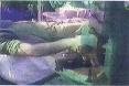 amputation