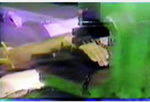 limb amputation150 limb amputation150