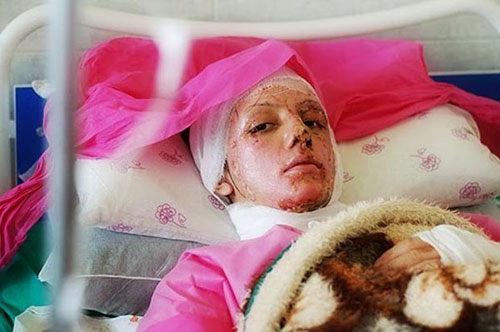 acid-attack-victims-500