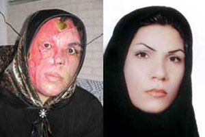 file-photo-victim-acid-attack